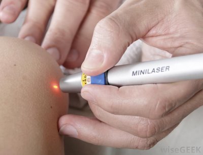 laser acupuncture to quit smoking effective or not